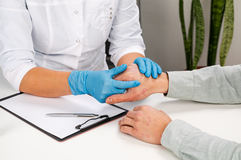 A healthcare provider examining a patient's hand with psoriasis symptoms in a clinical setting.