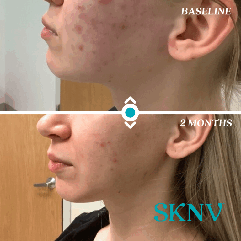 Before and after images showing visible acne improvement in a SKNV patient using Adermica Gel, a 4-in-1 compounded acne treatment.