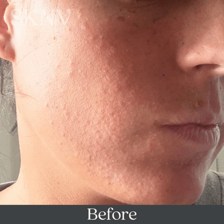 Cheek with visible irritation, dryness, and uneven texture before using SKNV’s eczema prescription.