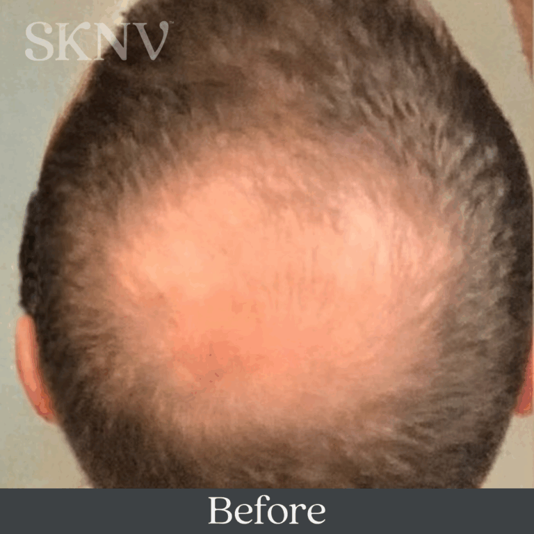 Scalp with visible thinning and reduced hair density before starting SKNV hair loss treatment.