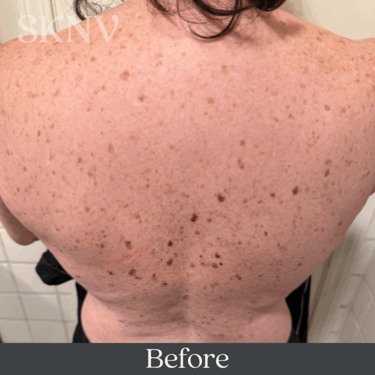 Back with scattered dark spots and uneven pigmentation before using SKNV Mekam Emulsion.