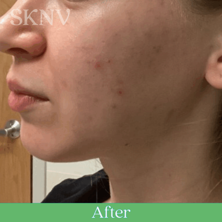 Cheek with reduced acne bumps and clearer skin after using SKNV Azalta HP.