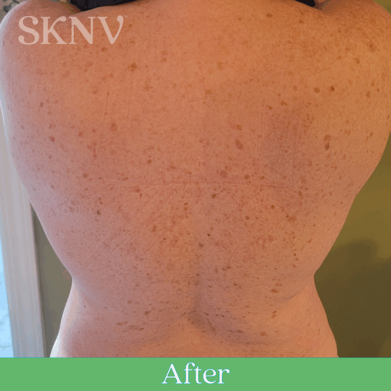 Back with more even tone and reduced dark spots after using SKNV Mekam Emulsion.