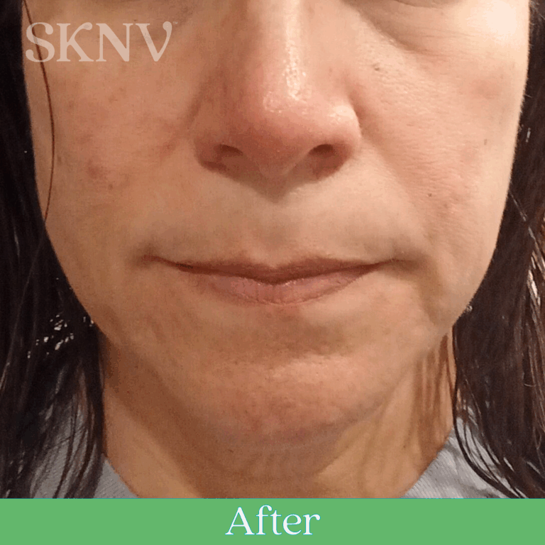 Reduced facial redness and clearer nose and cheeks after using SKNV Rositara Gel.