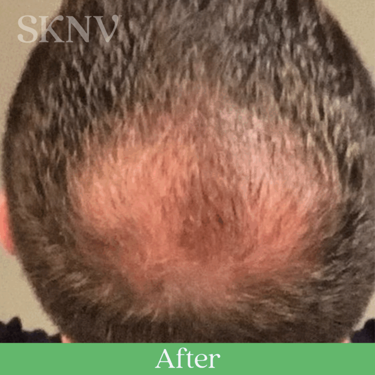 Scalp showing increased hair density and improved coverage after SKNV hair loss treatment.