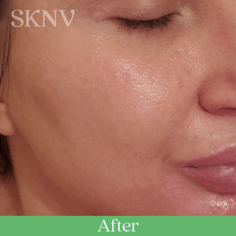 Results after using Rositara Gel