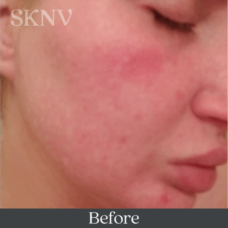 Cheek with reduced redness and smoother tone after using SKNV Rositara Gel.